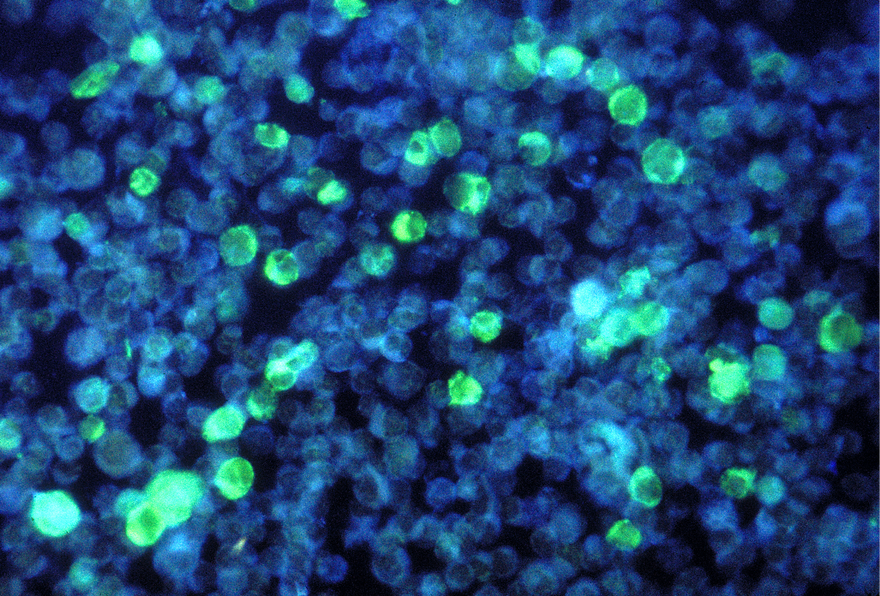 Photomicrograph depicting leukemia cells containing Epstein-Barr virus. Courtesy of the Public Health Image Library, Centers for Disease Control and Prevention, Dr. Paul M. Feorino.