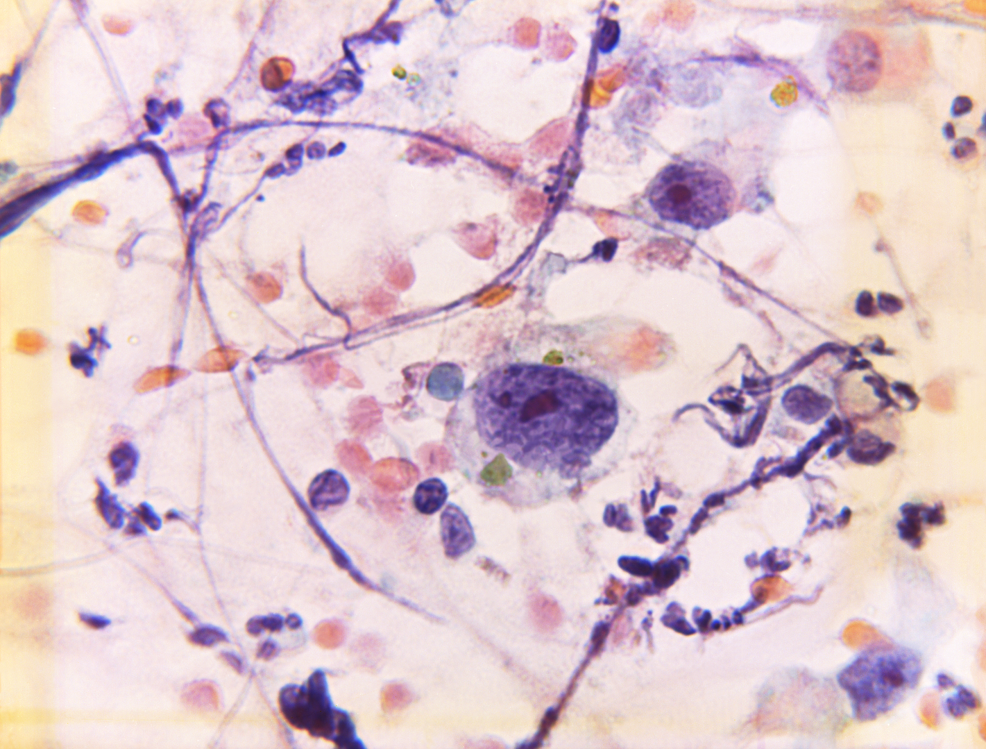 Photomicrograph of a Papanicolaou test. Courtesy of the Public Health Image Library, Centers for Disease Control and Prevention.